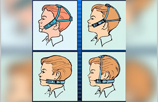 Ağız Dışı Apareyler